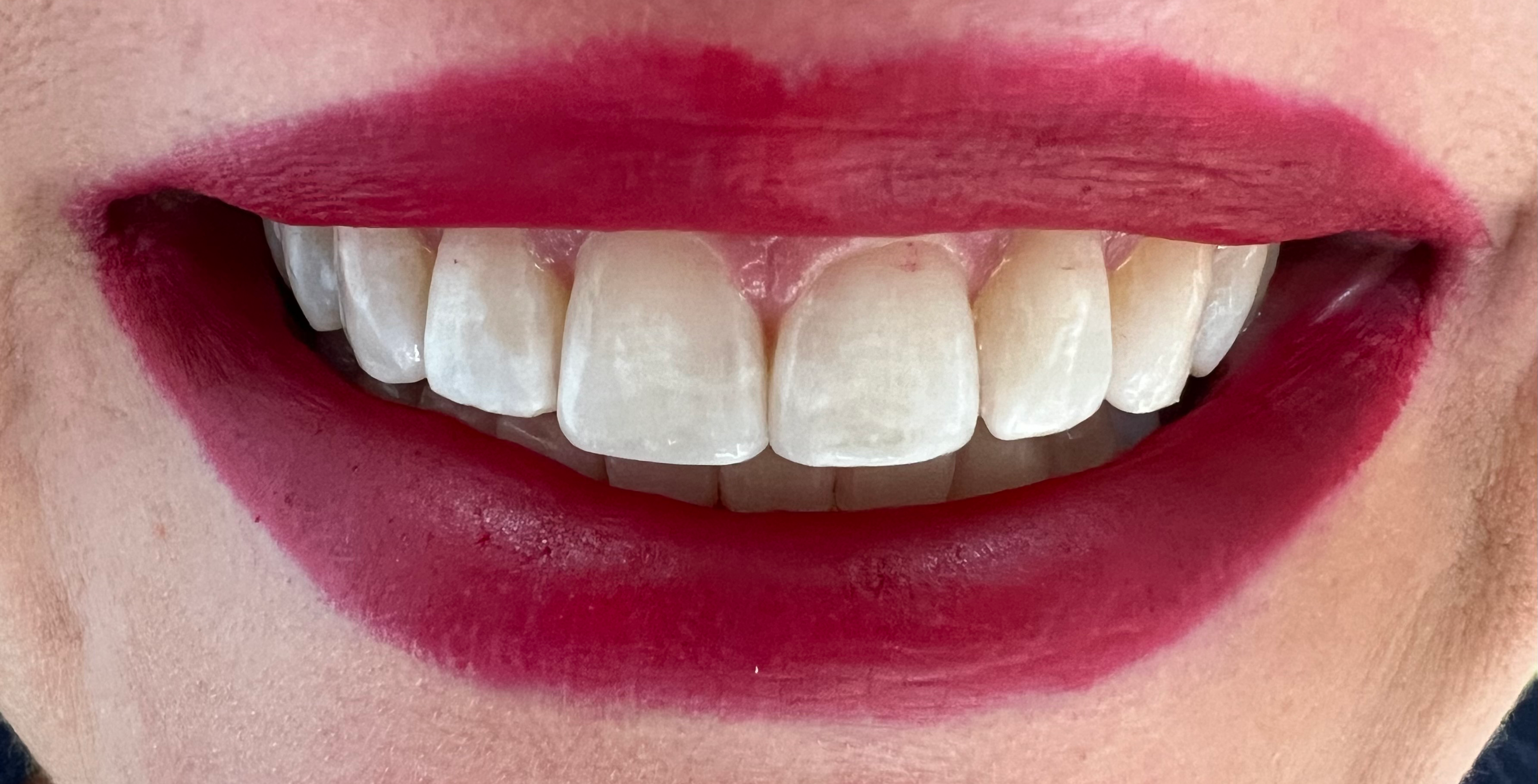 After - Invisalign - Finale