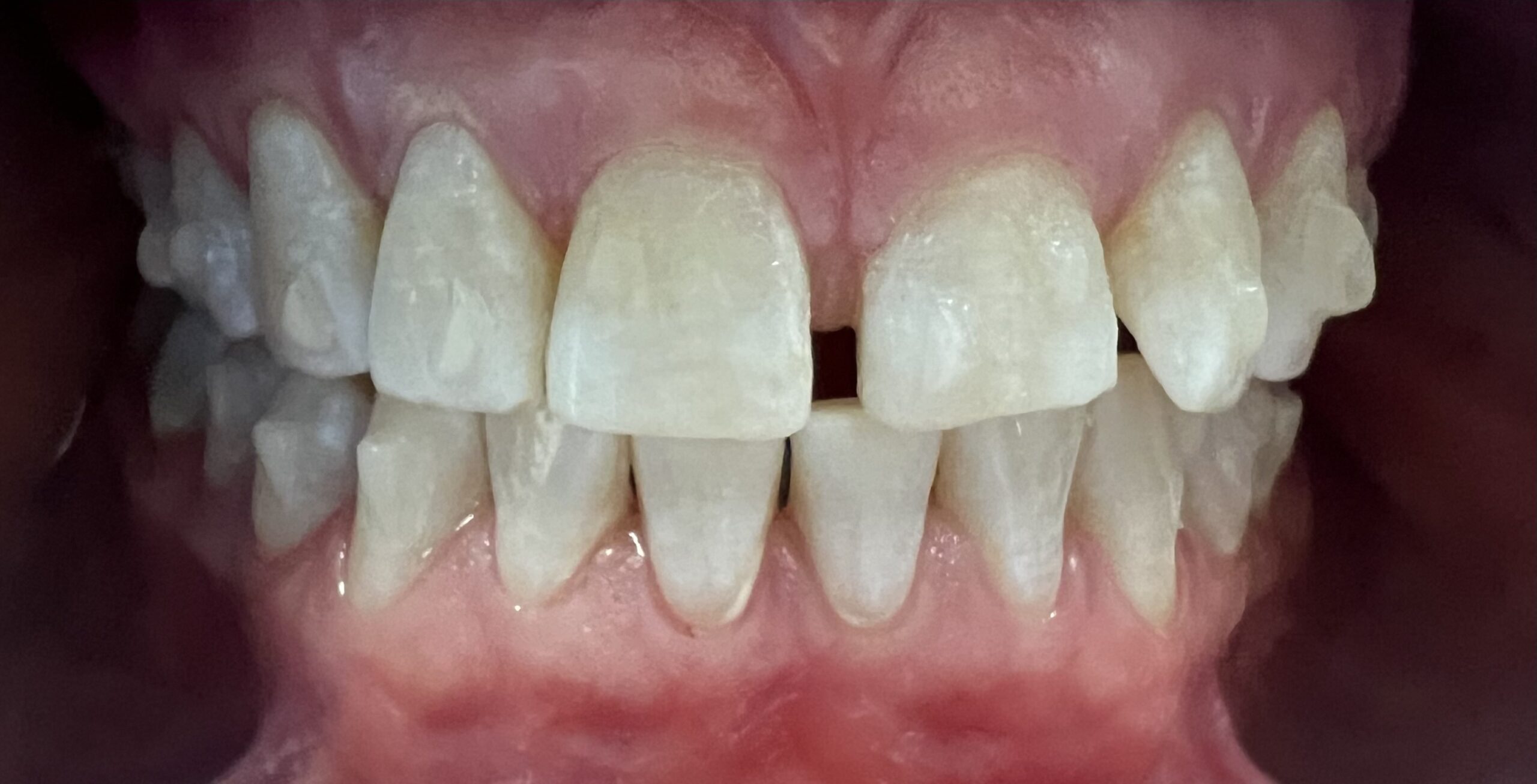 Before - Invisalign - Cropped